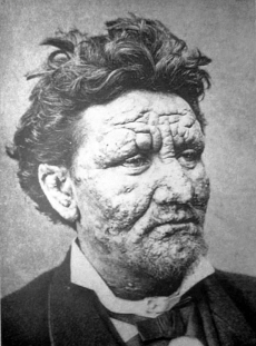Man who suffered from leprosy